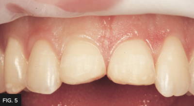 Anterior teeth with previous composite restorations removed
