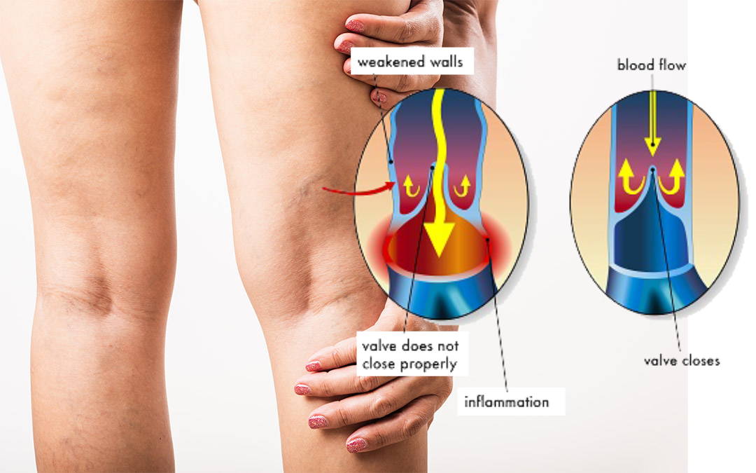 The image showcases varicose veins, illustrating a twisted vein alongside a healthy or normal vein for comparison.