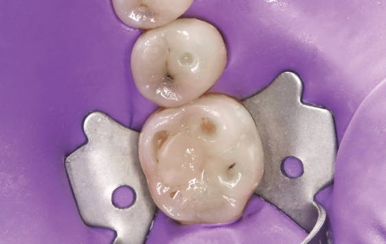 posterior tooth isolated with purple dental dam and metal clamp