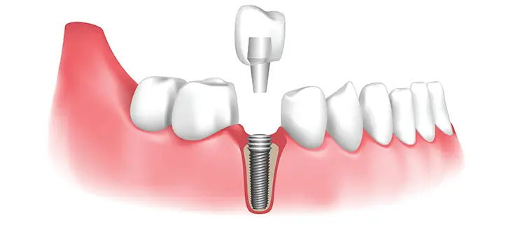 Dental Implant Procedures by Dental Assets | DentalAssets.com