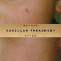 Before & After Pictures Dr Sknn Wilmslow Cheshire