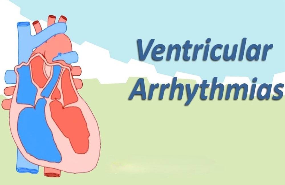 ventrikuläre Arrhythmie