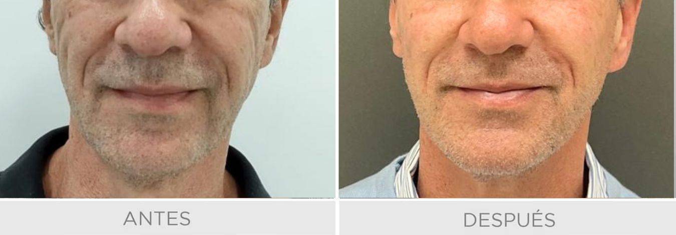 hialuronico mandibula hombre rellenos