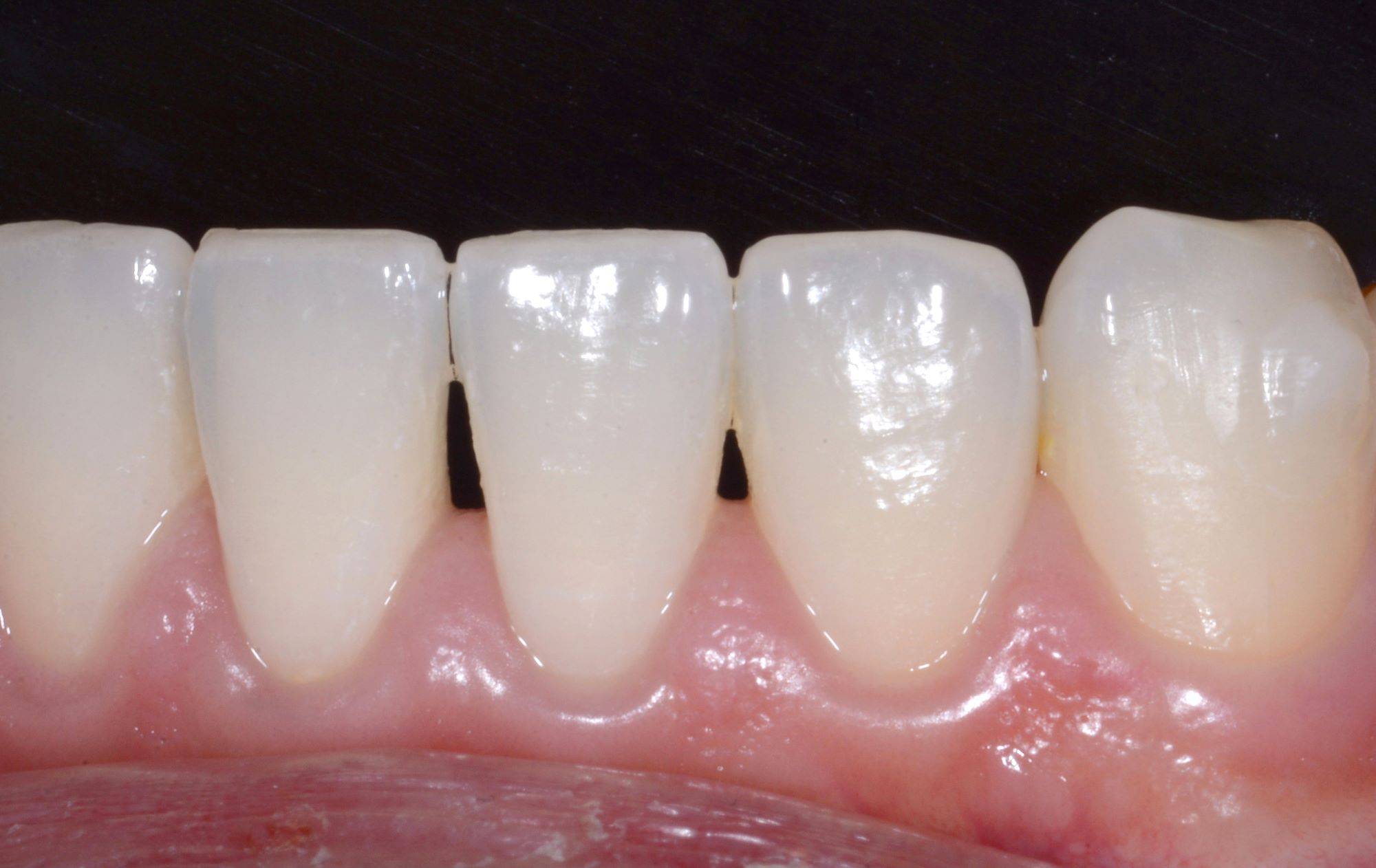 Close-up on smile showcasing small black triangle in lower central incisor and lower lateral incisor
