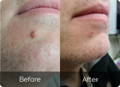 before and after mole remover