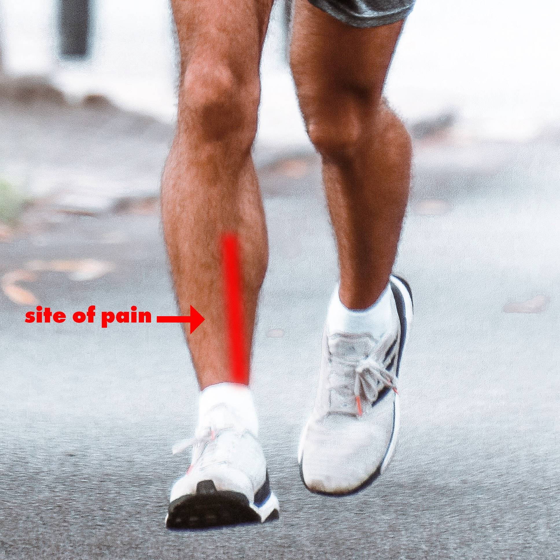 Shin splints cause pain on your shin bone