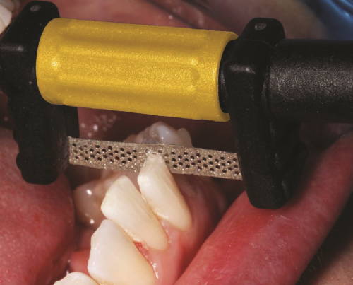 reducing enamel with yellow handle strip