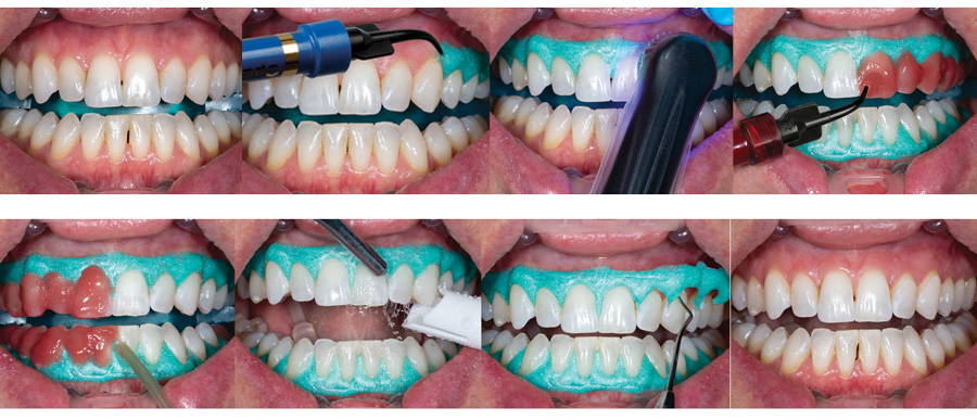 Opalescence Boost: In-office teeth bleaching administered by a dentist: step-by-step procedure