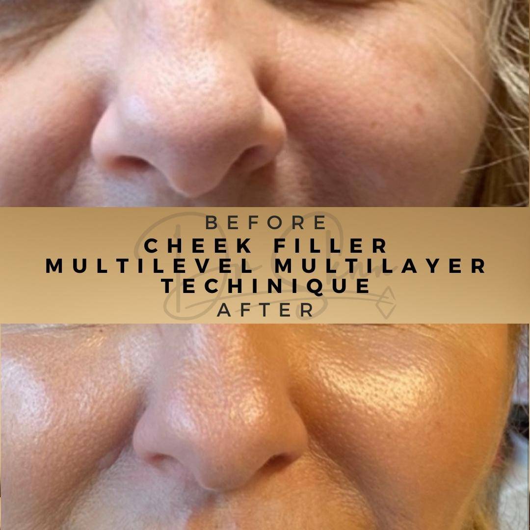 Cheek Fillers - Dr Sknn before and after