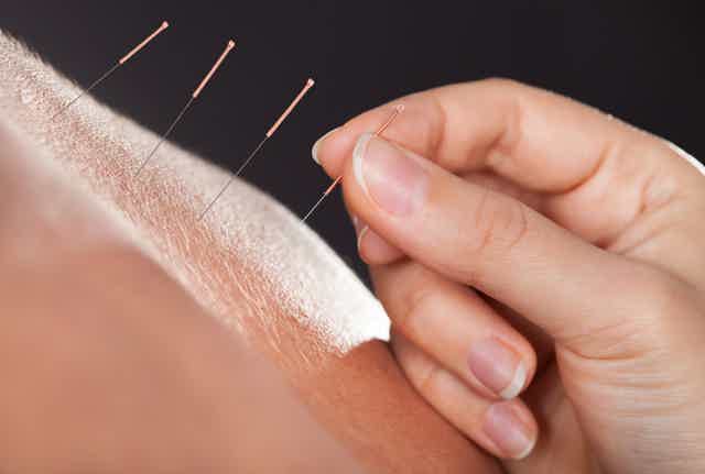 Acupuncture needles arranged on linen