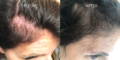 Nulastin-Scalp-Hair-Results-Before-After