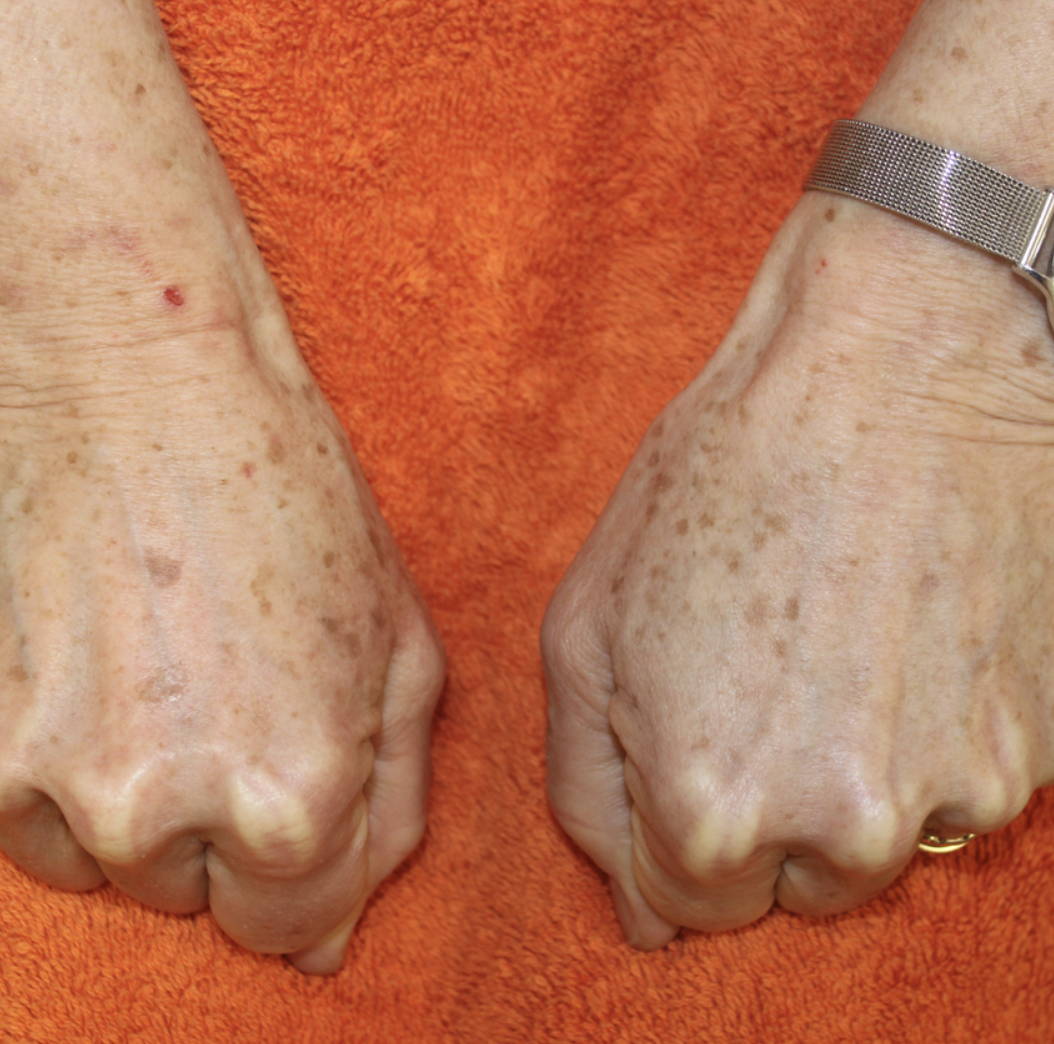Intense Pulsed Light Pigmentation Removal Before