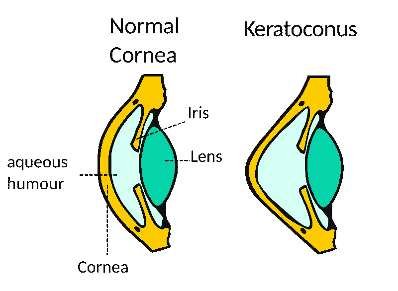 Cornea shape with keratoconus