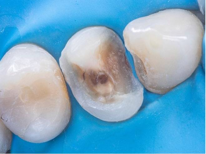 Tooth with decay exposed
