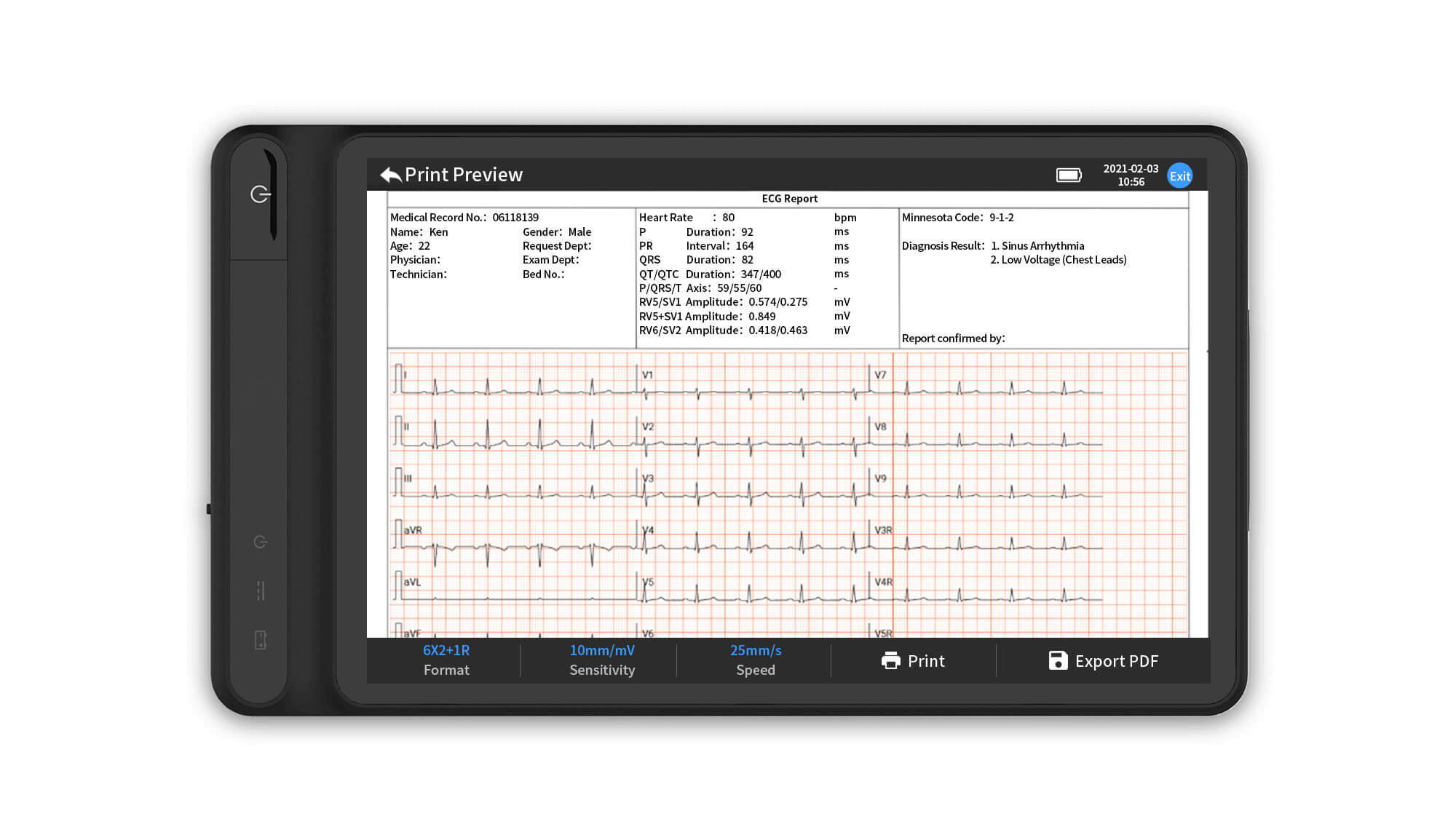 ECG report on the display to show waveforms and heart related data.