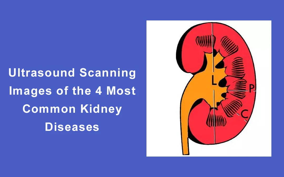 EagleView Wireless Ultrasound Scanning Images of the 4 Most Common Kidney Diseases