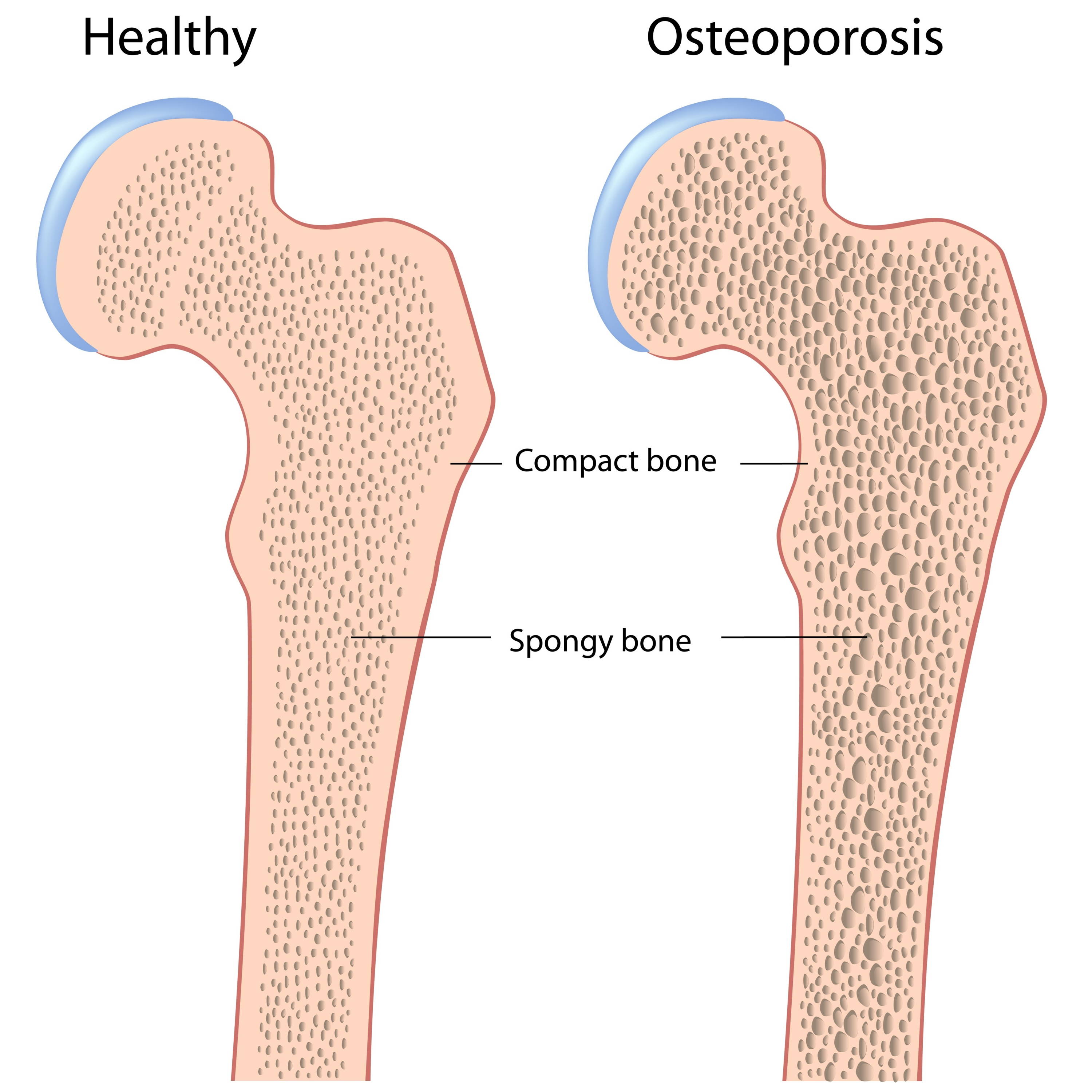 Увеличение плотно. Остеопороз большеберцовой кости. Остеопороз бедренной кости. Здоровая кость и остеопороз. Остеопороз тазобедренного сустава.