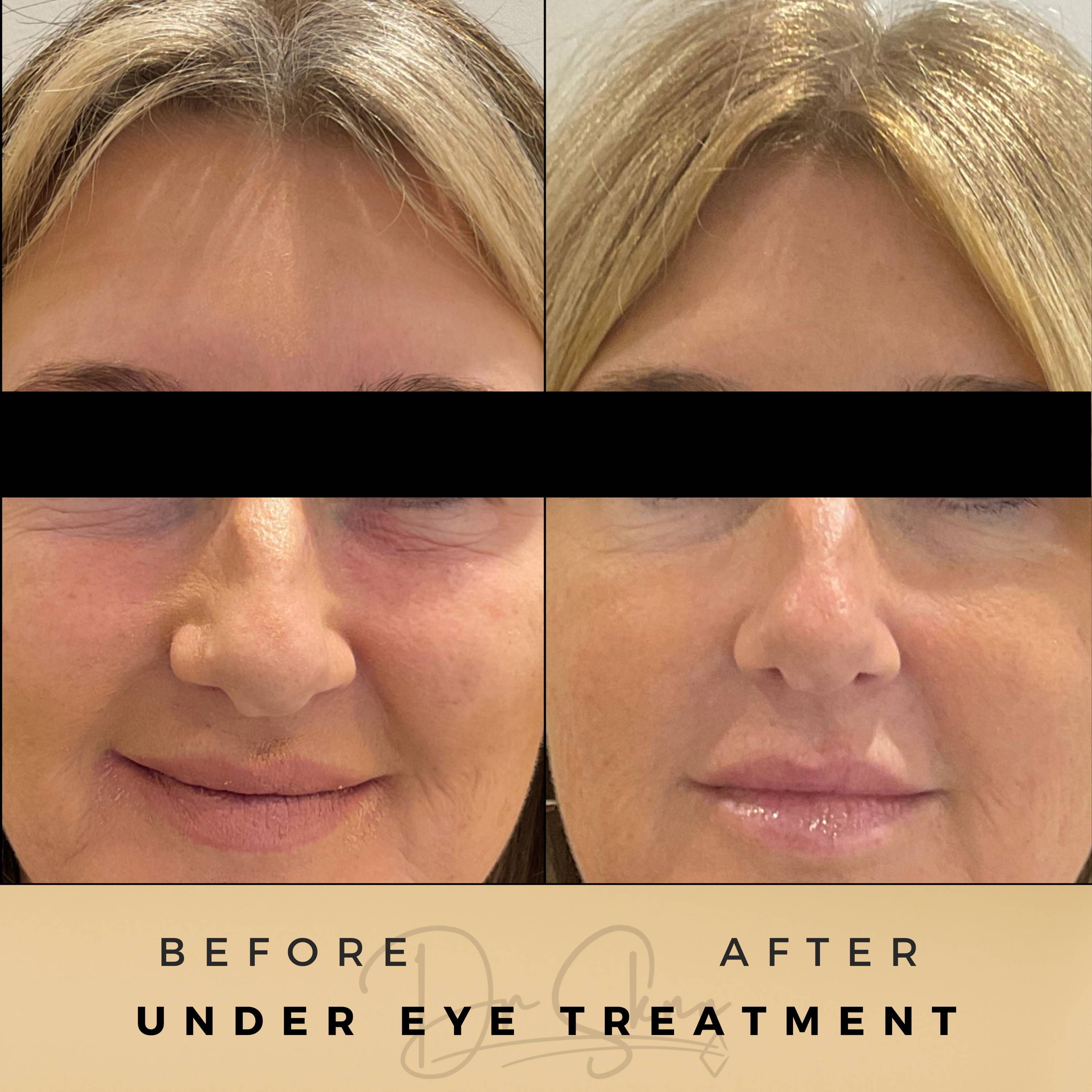 Under Eye Wrinkle Treatment