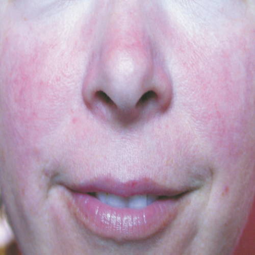 Intense Pulsed Light Vascular lesions After