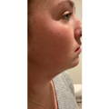 ONDA - NON-SURGICAL FAT REDUCTION, CELLULITE REDUCTION & SKIN TIGHTENING - before picture Submental / Neck