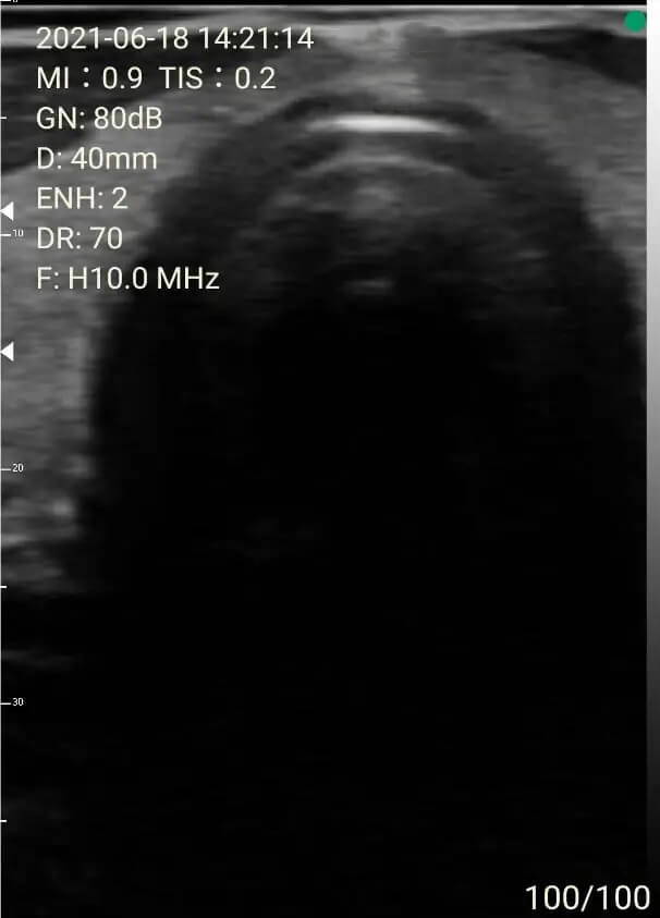 Thyroid isthmus and trachea ultrasound image scanned by EagleView portable ultrasound scanner