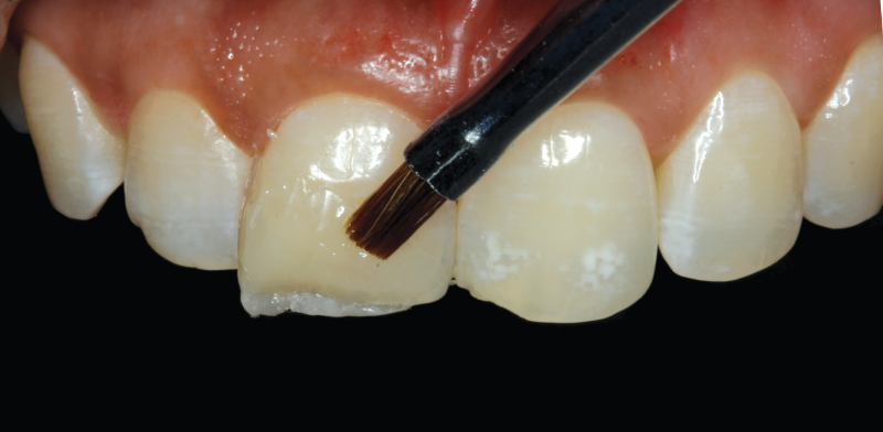 Uneven teeth with brush touching central incisor