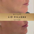 Lip Fillers Wilmslow with Anti-wrinkle injections