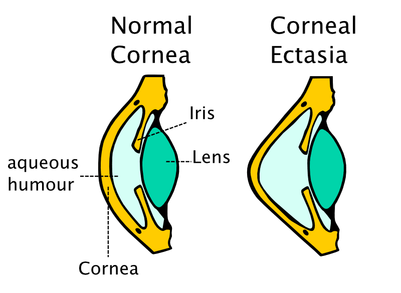 Change in shape from corneal ectasia after lasik