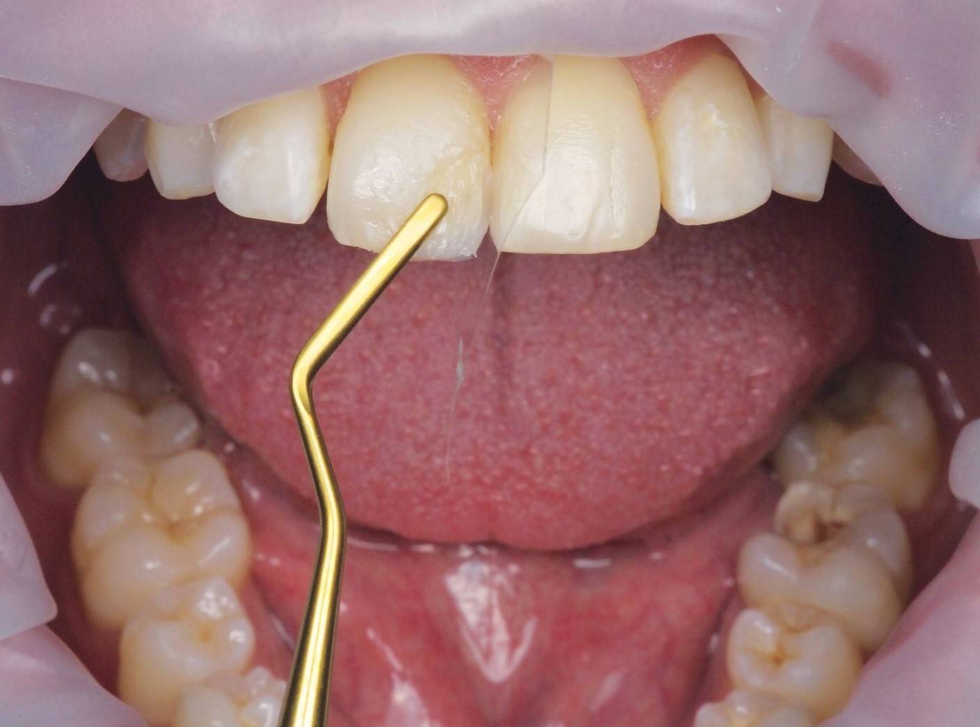 Composite instrument touching upper tooth being restored