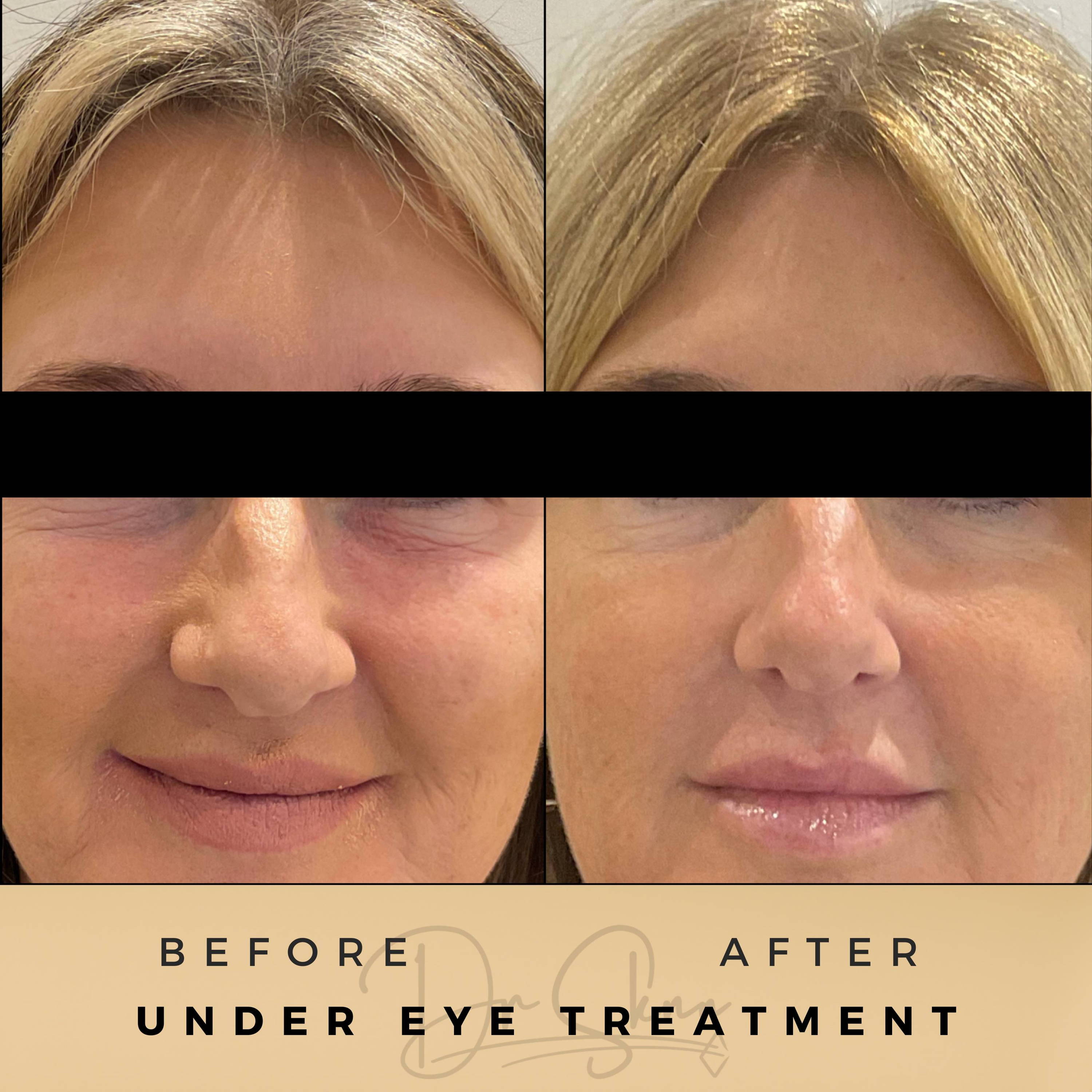 Under Eye Wrinkle Treatment Wilmslow Before & After Dr Sknn