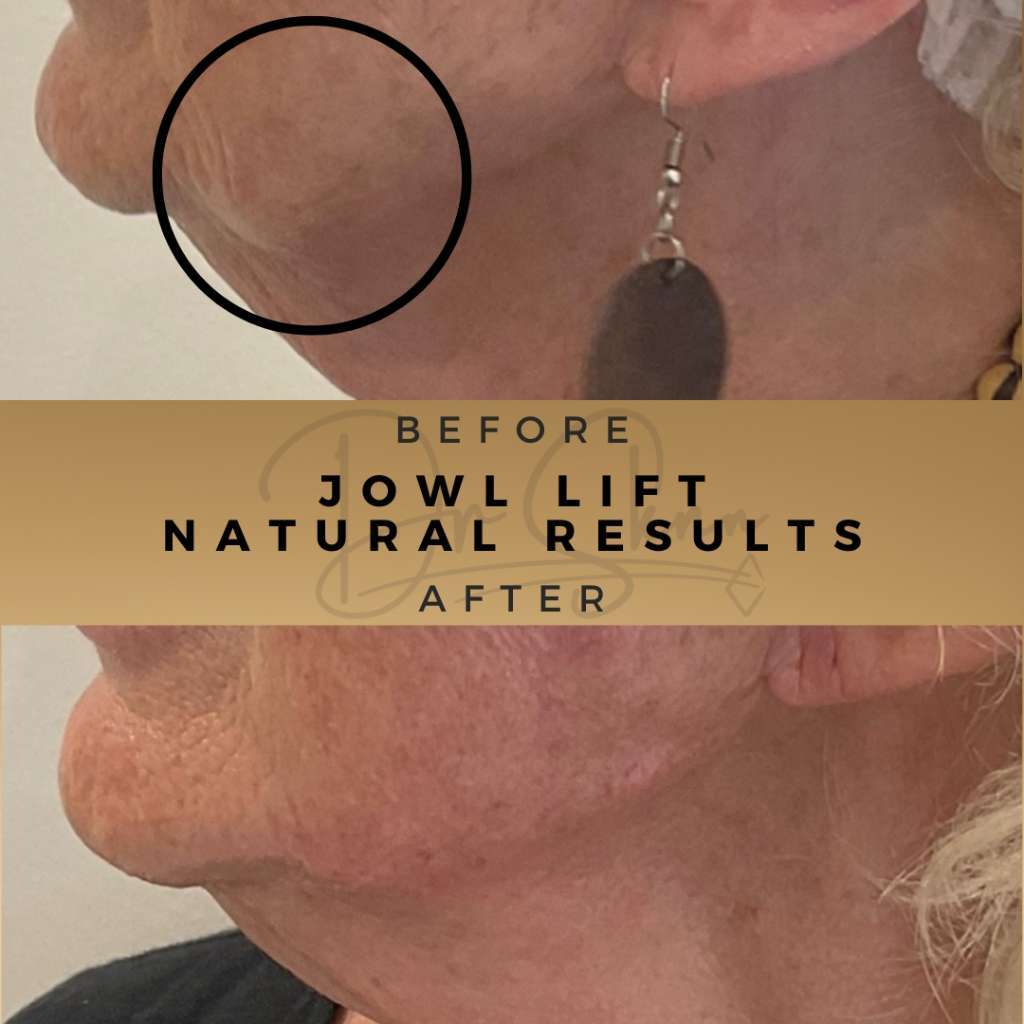 Jawline and lower face at Dr Sknn Wilmslow