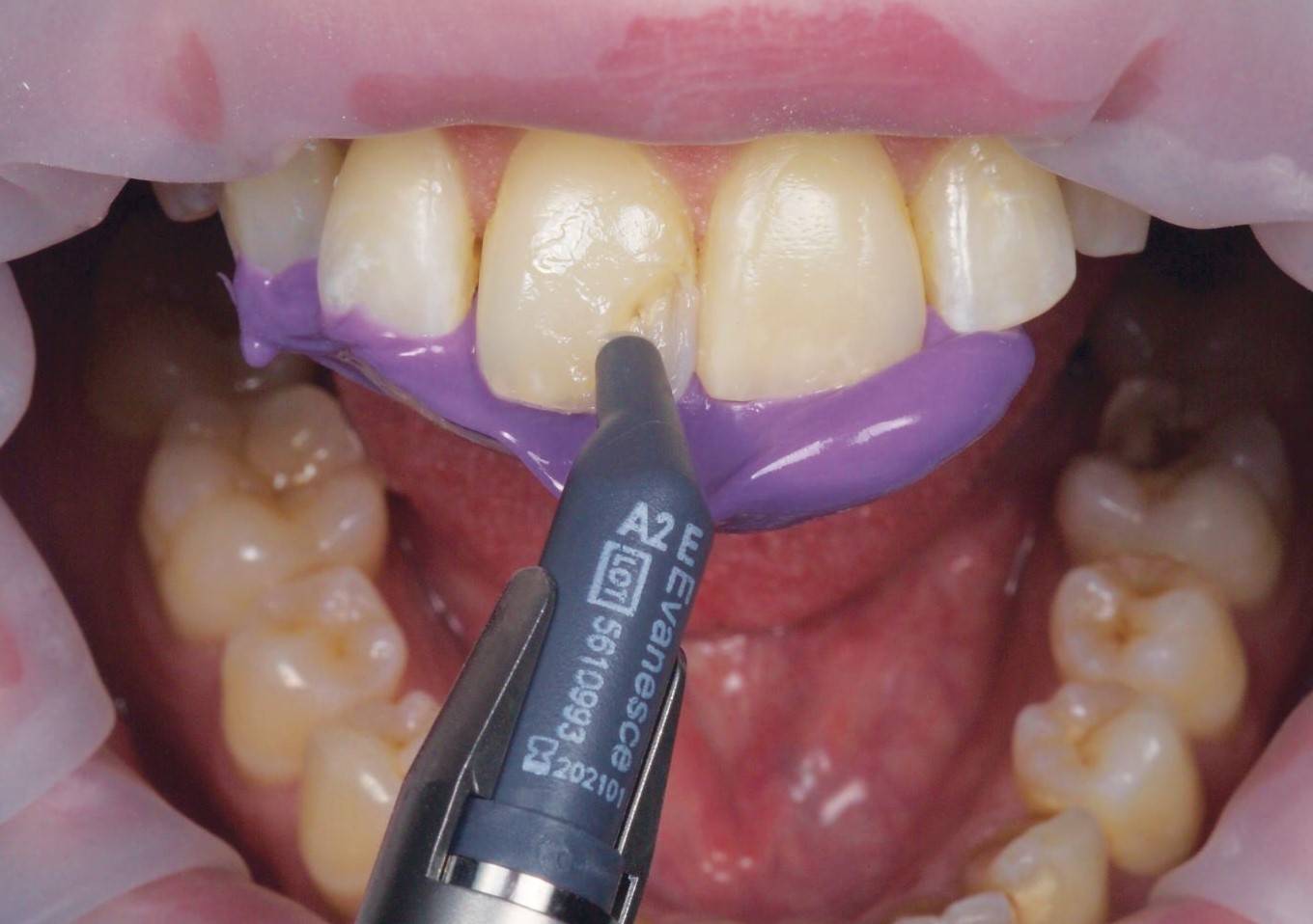 Open mouth with purple material attached to upper teeth while syringe applies another material to upper tooth