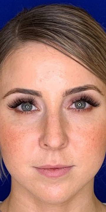 WunderHaut Anti-Aging Genius™ mit Radiofrequenz, LED Licht- und Mesotherapie, EMS und Elektroporation