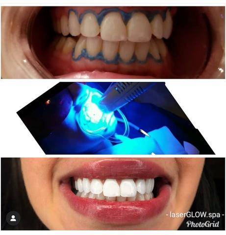 LaserGlow Spa Best LED Teeth Whitening Kit