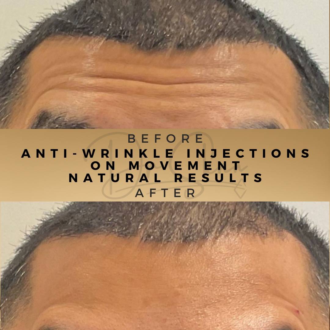 Anti-Wrinkle Injections Wilmslow Before & After Dr Sknn