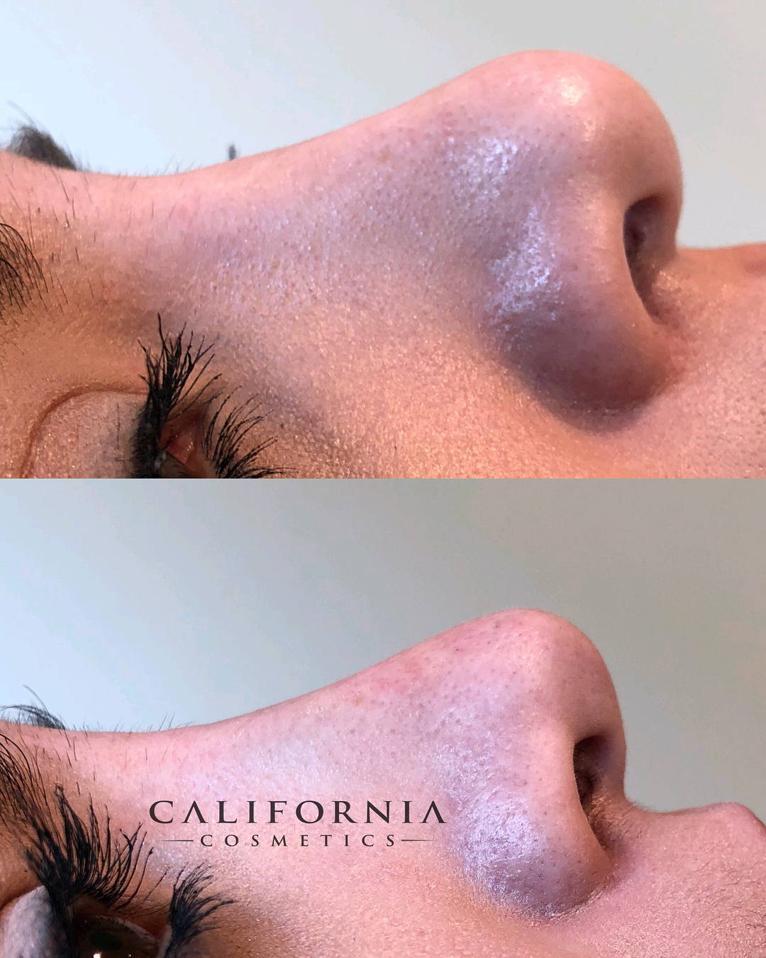 Woman's nose before and after nonsurgical nose job