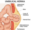 umbilical-hernia-diagram