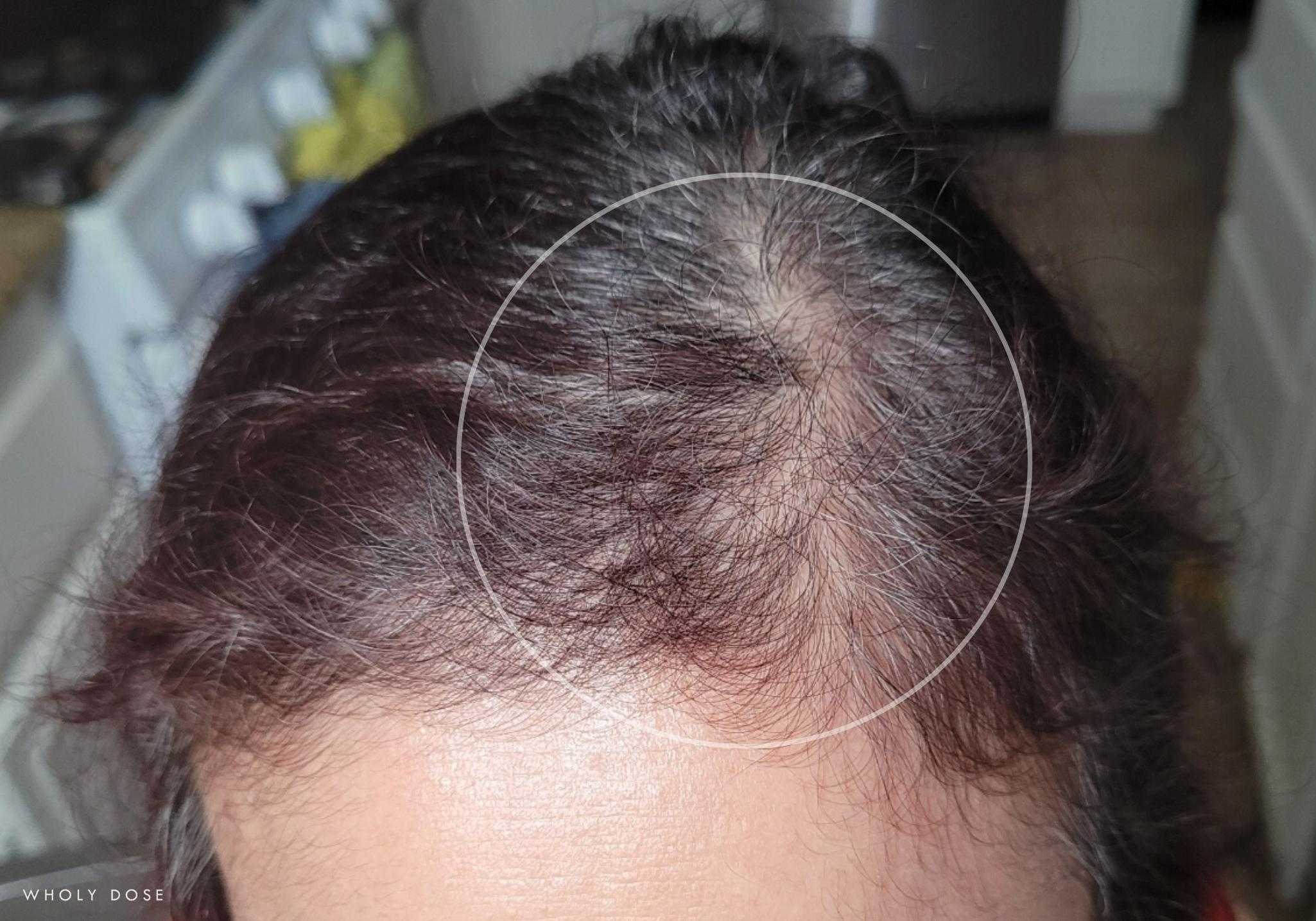 marine-collagen-biotin-hyaluronic-acid-supplement-before-after-hair-growth-results-1