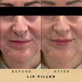 Lip Fillers Wilmslow with Anti-wrinkle injections