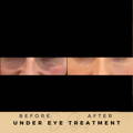 NCTF135 Under Eyes Before & After Wilmslow, Cheshire Dr Sknn Aesthetic