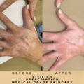 Vitiligo Treatment Before & After Pictures Dr Sknn Wilmslow Cheshire