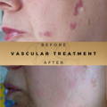 IPL Vascular Lesion Removal Wilmslow Dr Sknn Before & After Picture