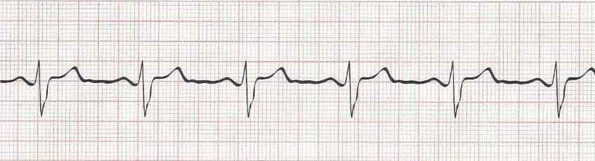 Sinus Bradycardia — 1st Degree AV Block (PR 0.22 seconds)