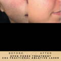 Skin Rejuvenation Co2 Fractional Laser Wilmslow Dr Sknn Before & After Picture