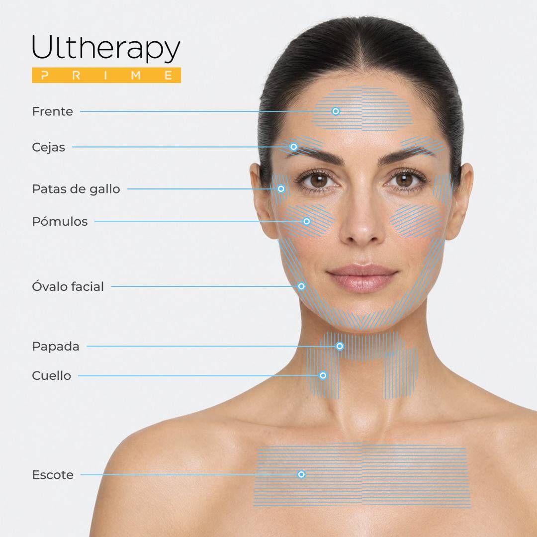 Zonas de tratamiento con Ultherapy PRIME: cejas, patas de gallo, pómulos, óvalo facial, papada, cuello y escote