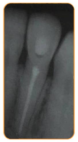 6 month recall after final obturation showing excellent healing and regression of the lesion 