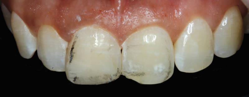 anterior teeth with pencil marks