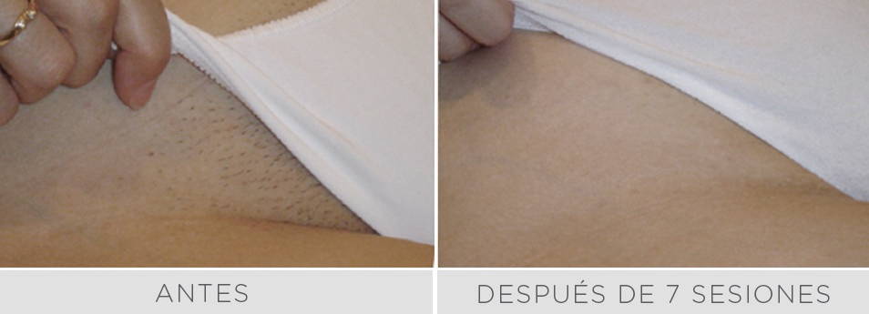 Antes y después de 7 sesiones de depilación láser en cavado