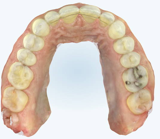 Scan of upper teeth