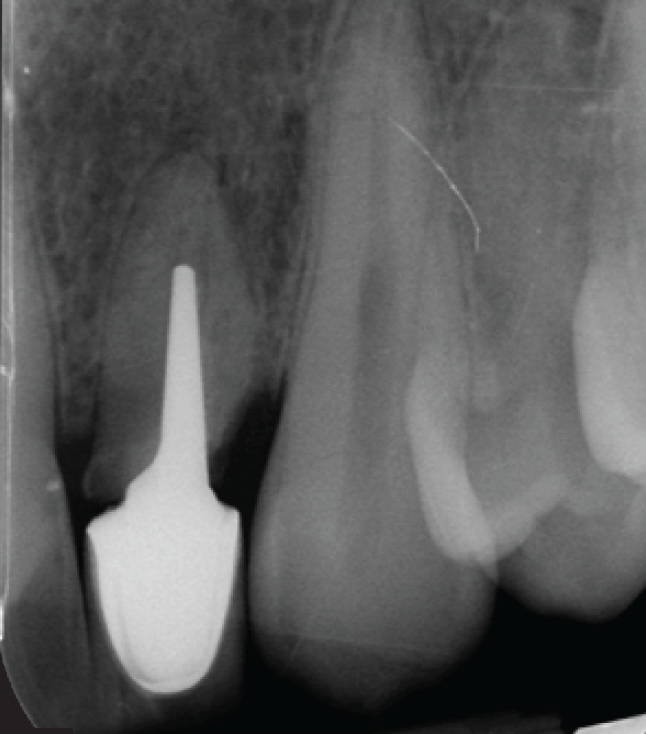 X-ray showing failing on #10